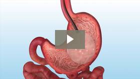 Watch Video of ORBERA Weight Loss Balloon Removal