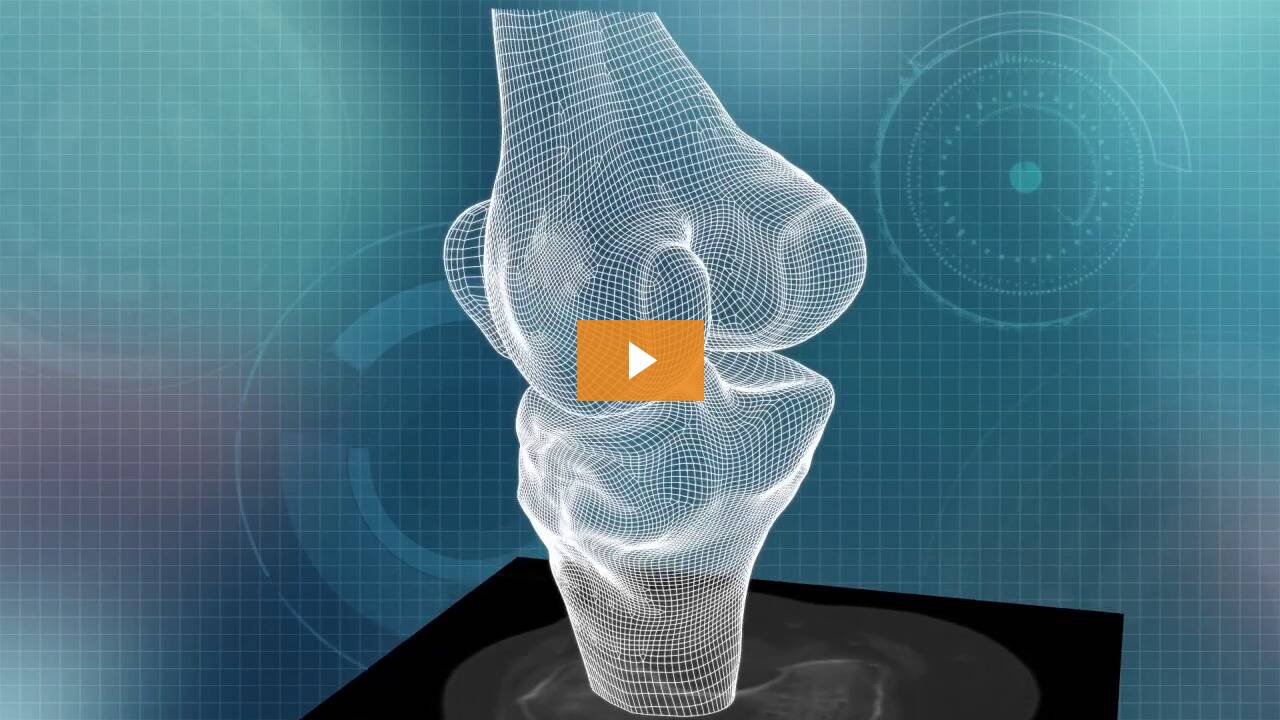 ConforMIS iFit Image-to-Implant Technology Video