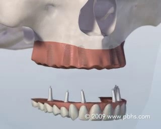 Wistia video thumbnail - Teeth_In_An_Hour_320