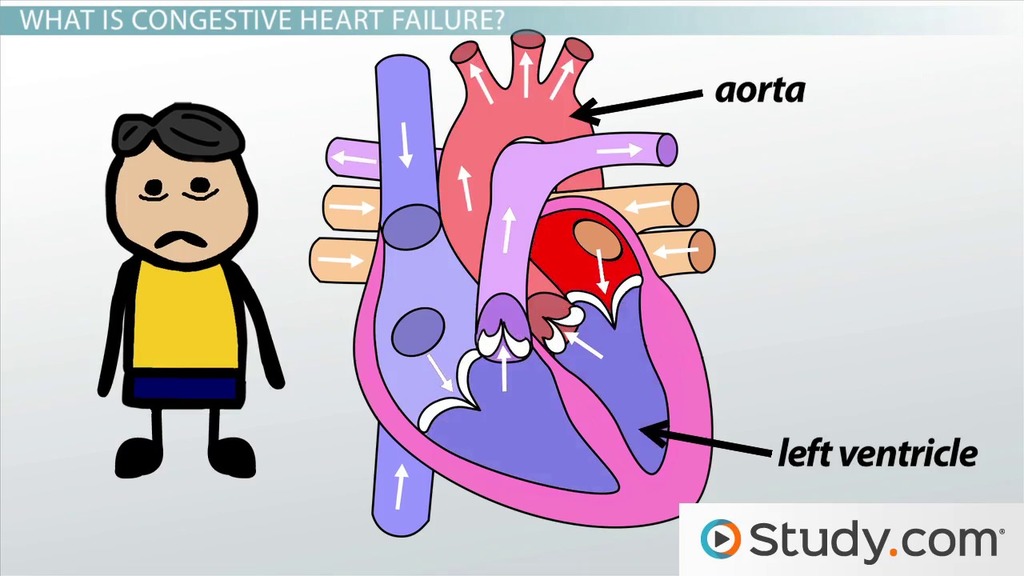 Diet And Congestive Heart Failure