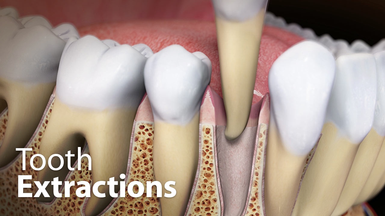 tooth extractions lange orthodontics milford ohio