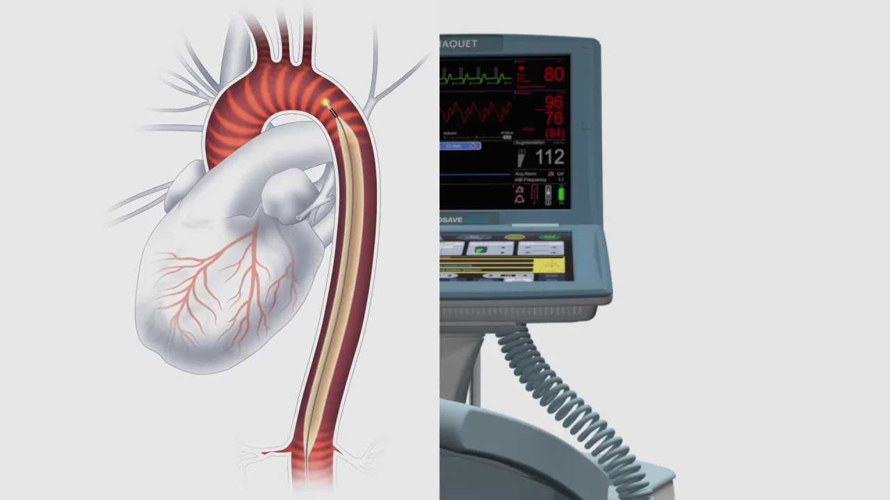 MCV00100190 REVA Cardiosave Overview