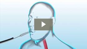 Video of ORBERA Gastric Balloon Placement