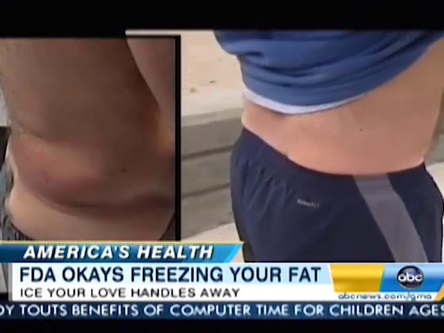 Coolsculpting Mat Su Plastic Surgerymat Su Plastic Surgery