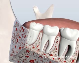 An illustration of a wisdom tooth